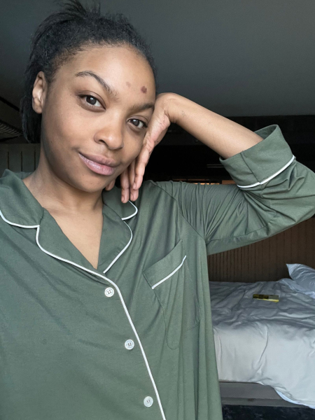 The writer seen here in March 2024 by which time she says the scars had darkened.